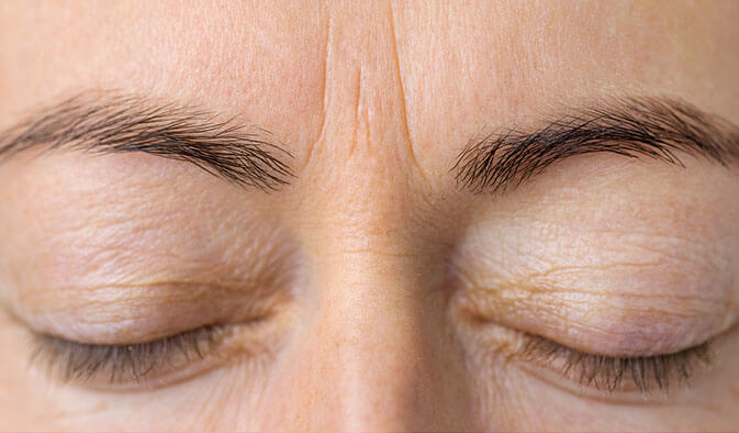 Botox Vorher/Nachher
